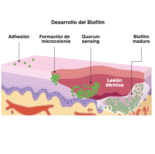 lesión en la piel provocada por malassezia formando el biofilm