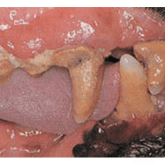 afecciones dentales sarro, gingivitis, placa y mal aliento